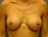 Patient # 22867 After Photo # 2