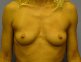 Patient # 22867 Before Photo # 1