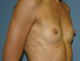 Patient # 45323 Before Photo # 1