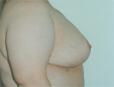 Patient # 35540 After Photo # 2