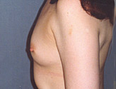 Patient # 20450 Before Photo # 5