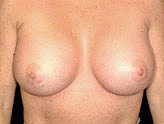 Patient # 33652 After Photo # 2