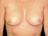 Patient # 33652 Before Photo # 1