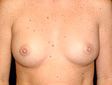 Patient # 58457 Before Photo # 1