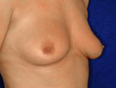 Patient # 99277 Before Photo # 1