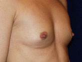 Patient # 68363 Before Photo # 1