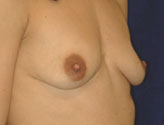Patient # 84820 Before Photo # 1