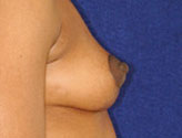 Patient # 26115 After Photo # 2