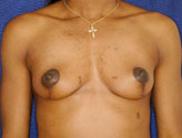 Patient # 26115 After Photo # 4