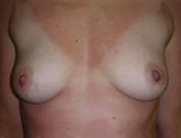 Patient # 22648 Before Photo # 1