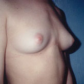 Patient # 40183 Before Photo # 1