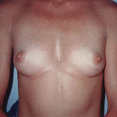 Patient # 96210 Before Photo # 1