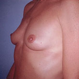 Patient # 11845 Before Photo # 1