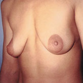 Patient # 30859 Before Photo # 1