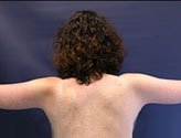 Patient # 86114 After Photo # 2