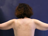 Patient # 86114 Before Photo # 1