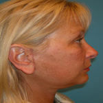Patient # 29680 After Photo # 4