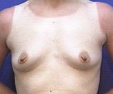 Patient # 84943 Before Photo # 1