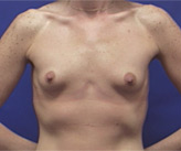 Patient # 40109 Before Photo # 1