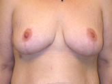 Patient # 57890 After Photo # 2