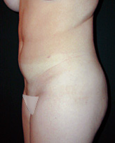 Patient # 31995 After Photo # 4