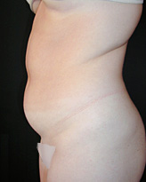 Patient # 31995 Before Photo # 3