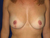 Patient # 98326 After Photo # 2