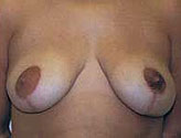 Patient # 80040 After Photo # 2