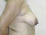Patient # 90482 Before Photo # 1