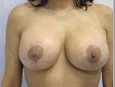 Patient # 22529 After Photo # 2