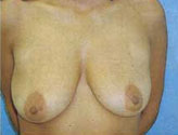 Patient # 22529 Before Photo # 1