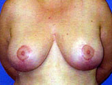 Patient # 87429 After Photo # 2