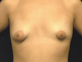 Patient # 36325 Before Photo # 1