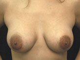 Patient # 84126 After Photo # 2