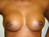 Patient # 85247 After Photo # 2