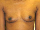 Patient # 85247 Before Photo # 1
