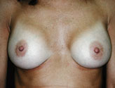 Patient # 92291 After Photo # 2
