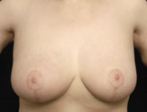 Patient # 12747 After Photo # 2