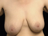 Patient # 12747 Before Photo # 1
