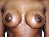 Patient # 55136 After Photo # 2