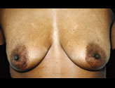 Patient # 55136 Before Photo # 1