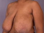 Patient # 60356 Before Photo # 3