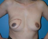 Patient # 58149 After Photo # 2