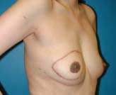 Patient # 58149 After Photo # 4
