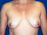 Patient # 46160 Before Photo # 1