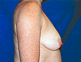Patient # 46160 Before Photo # 5