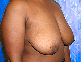 Patient # 26904 Before Photo # 3