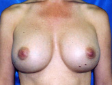 Patient # 61448 After Photo # 2