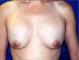 Patient # 61448 Before Photo # 1