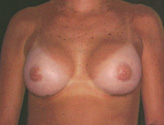 Patient # 63469 After Photo # 2